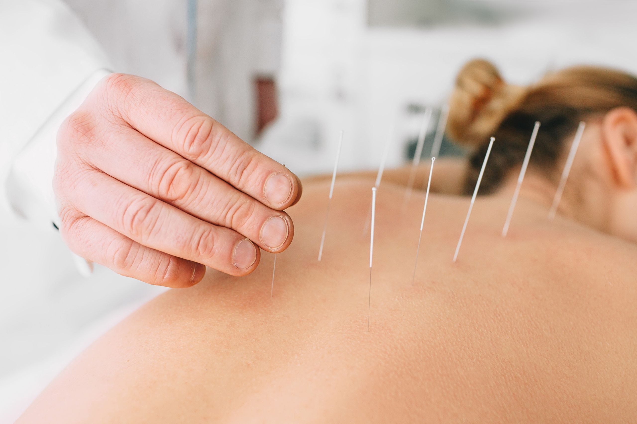 A close-up of a man's hand applying acupuncture needles into a woman's back