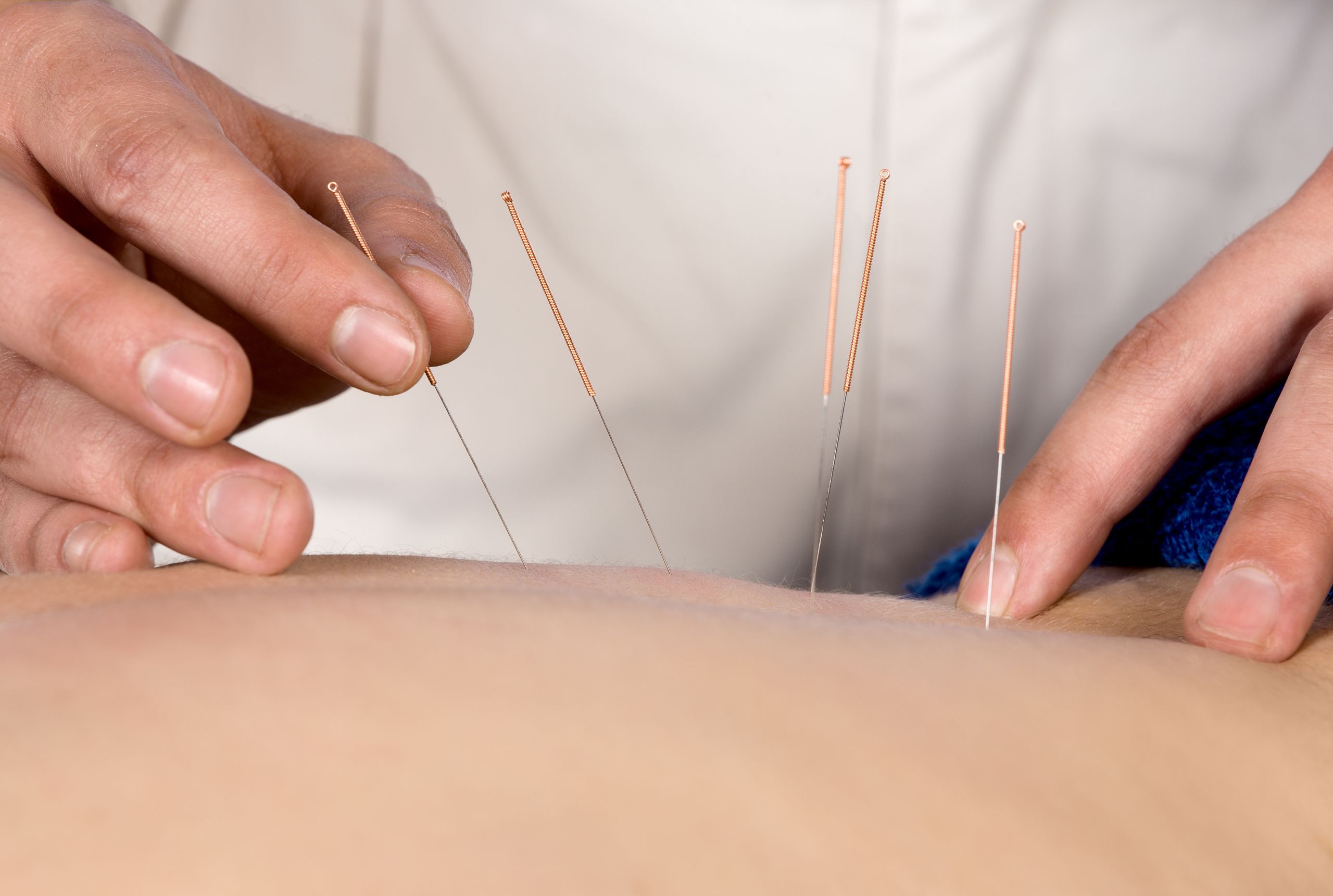 close-up of a hand placing acupuncture needles into skin