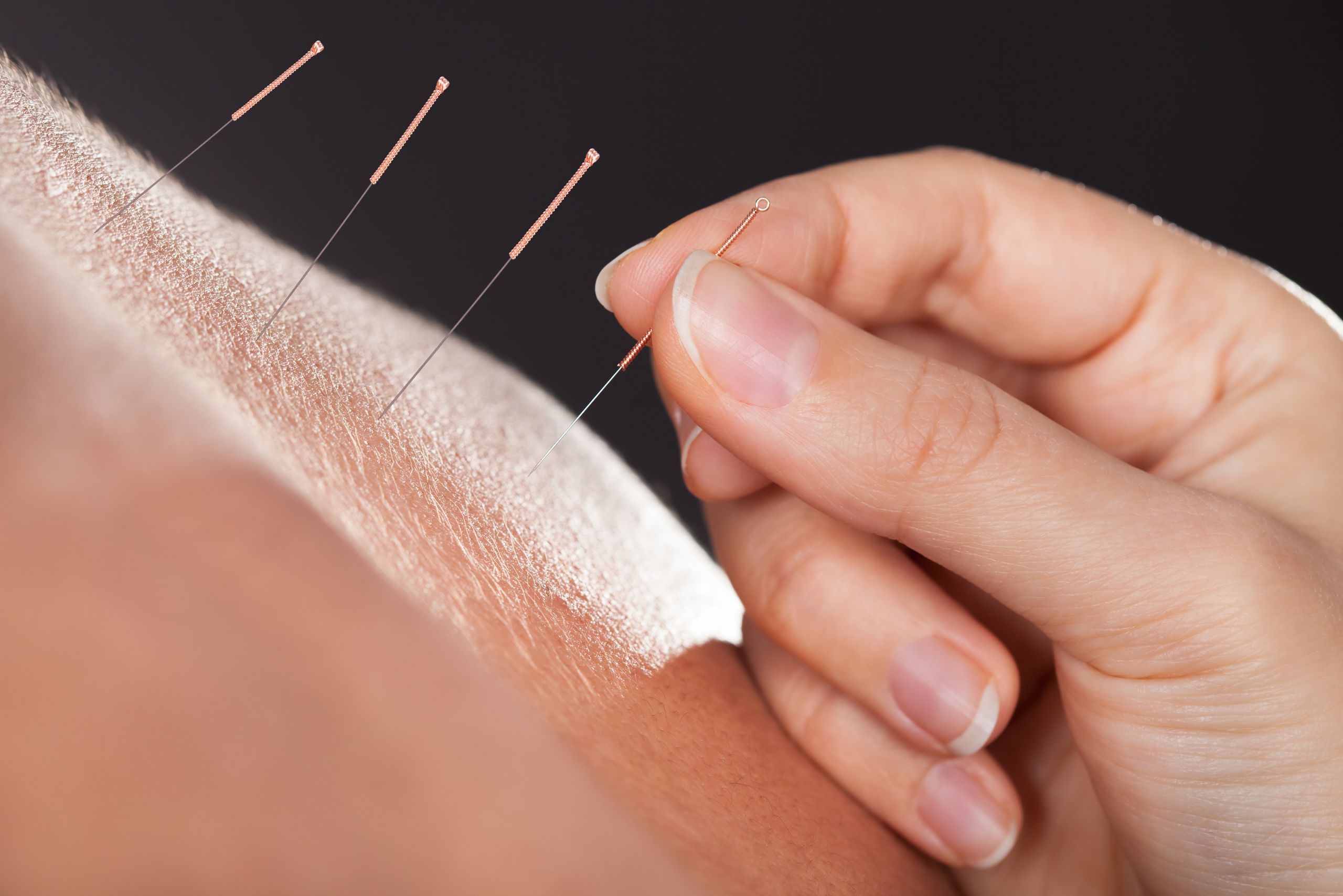 A close-up of a woman's hand applying acupuncture needles into skin